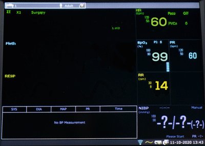 Монитор пациента EDAN X8