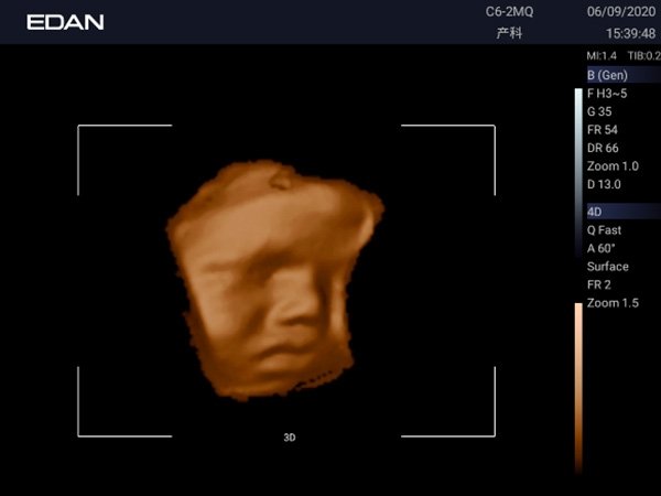 Edan Acclarix AX3 УЗИ-сканер
