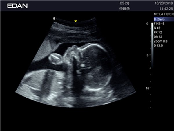 Edan Acclarix AX3 УЗИ-сканер