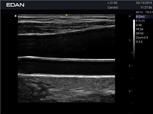 Edan Acclarix AX3 УЗИ-сканер